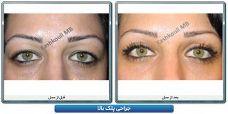 جراحی زیبایی چشم