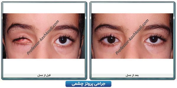 جراحی چشم مصنوعی